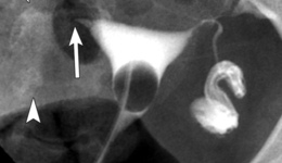 Фото: Отсутствие маточных труб