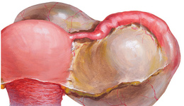 Фото: Пиосальпинкс