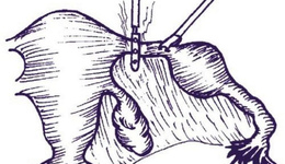 Фото: Тубэктомия