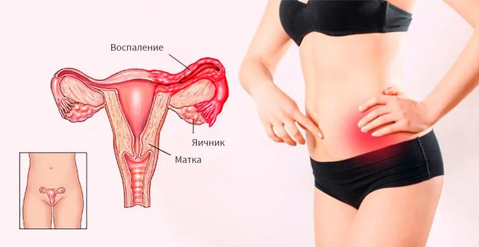 Фото: Особенности острого аднексита