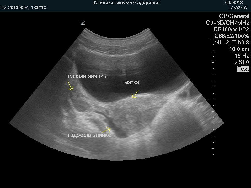 Фото: Гидросальпинкс на УЗИ