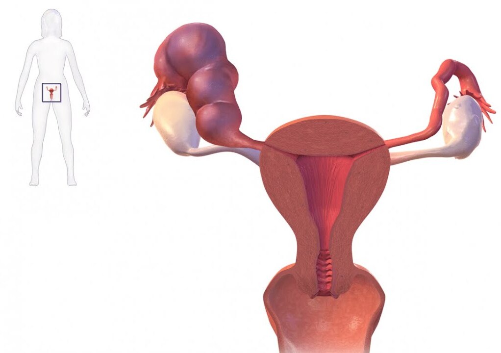 Фото: Что такое гидросальпинкс