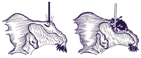 Фото: Хирургическое лечение пиосальпинкса