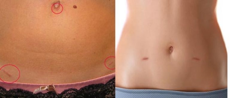 Фото: Последствия удаления маточных труб