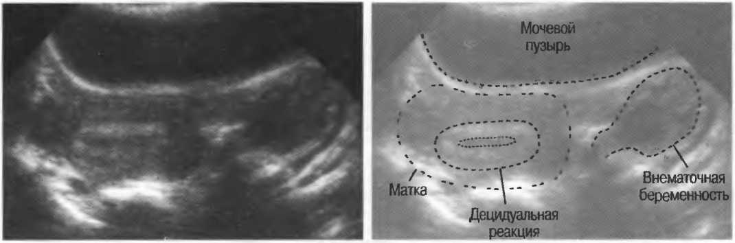 Фото: Дифференциальная диагностика внематочной беременности